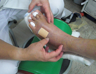 骨折・シーネ固定中