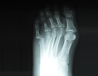左第5趾MP脱臼及び第4趾骨折
