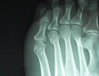 左第5趾MP脱臼及び第4趾骨折